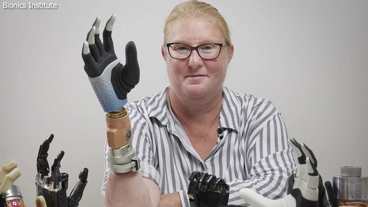 Meet the first person ever to receive a fully functional bionic hand with AI – The TechLead